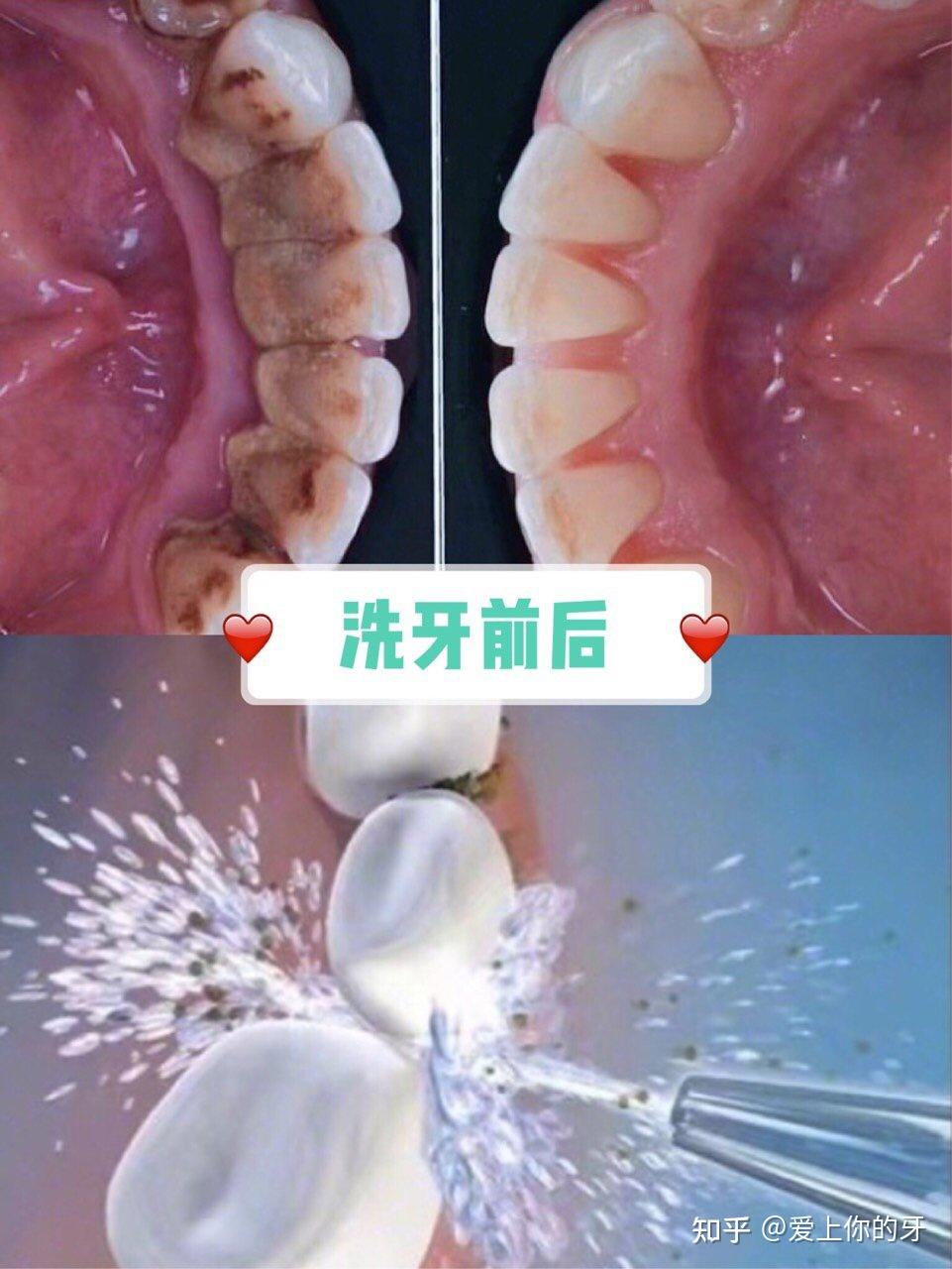 汉中洗牙可以用医保吗(洗牙可以用医保吗,报销比例多少)